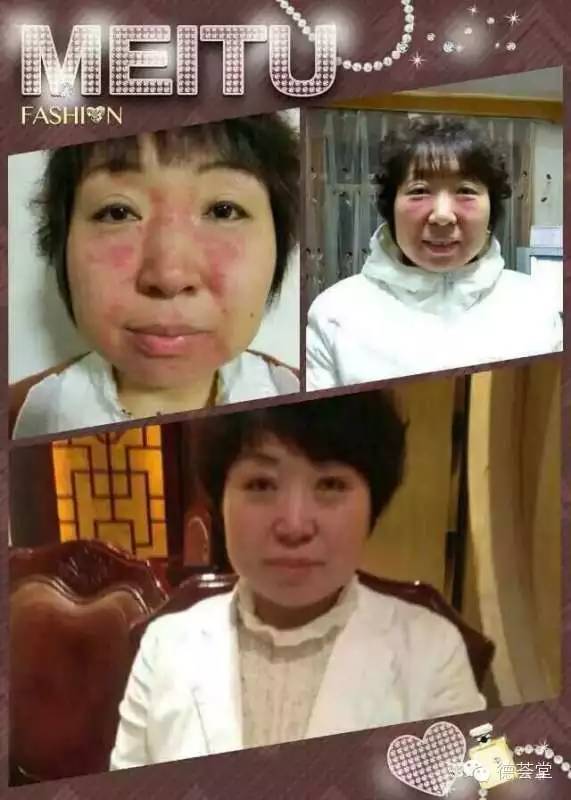 咖啡灌肠副作用_咖啡副灌肠作用大吗_咖啡灌肠的副作用