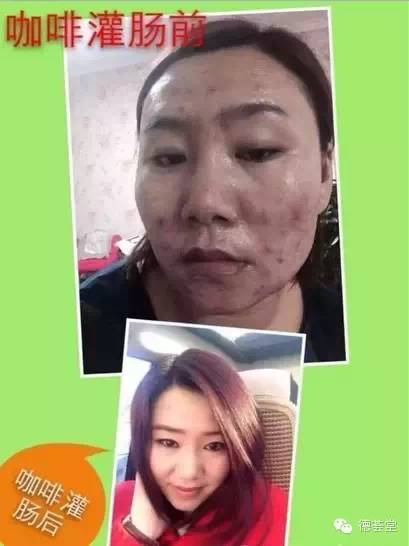 咖啡灌肠副作用_咖啡副灌肠作用大吗_咖啡灌肠的副作用