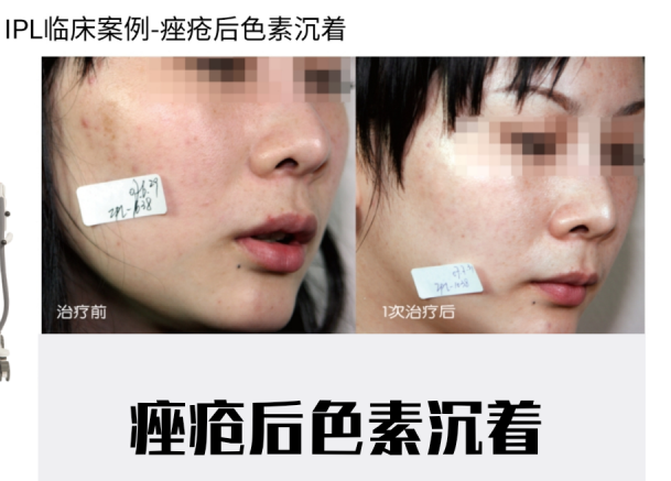 宝宝咖啡斑饮食需要注意什么_宝宝咖啡斑哭闹会变红吗_宝宝咖啡斑图片