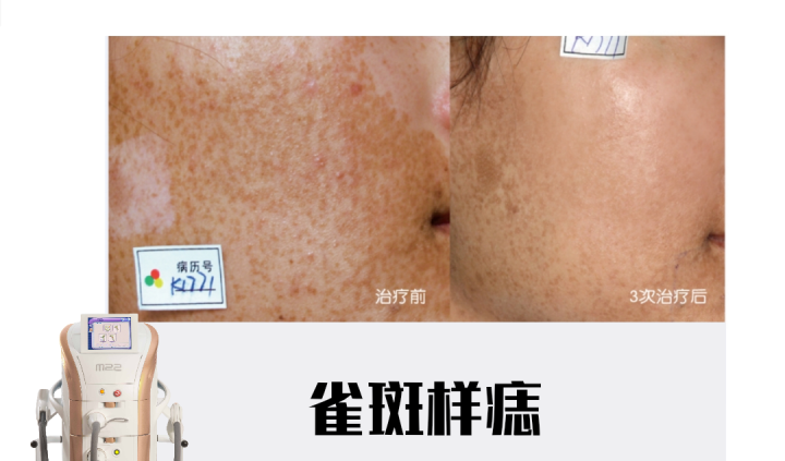 宝宝咖啡斑饮食需要注意什么_宝宝咖啡斑哭闹会变红吗_宝宝咖啡斑图片