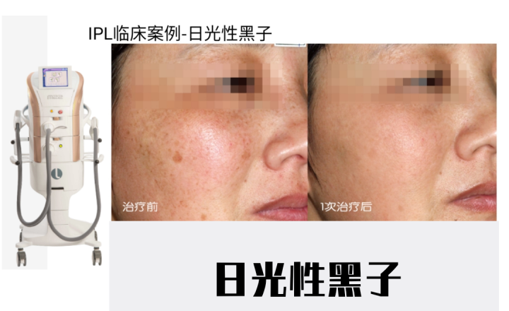 宝宝咖啡斑图片_宝宝咖啡斑饮食需要注意什么_宝宝咖啡斑哭闹会变红吗