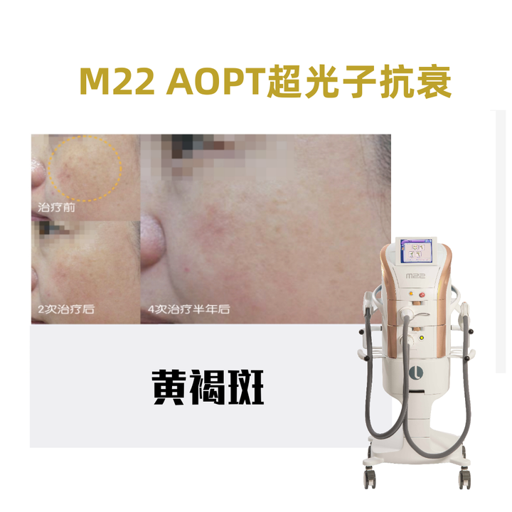 宝宝咖啡斑图片_宝宝咖啡斑饮食需要注意什么_宝宝咖啡斑哭闹会变红吗