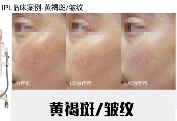 宝宝咖啡斑哭闹会变红吗_宝宝咖啡斑饮食需要注意什么_宝宝咖啡斑图片
